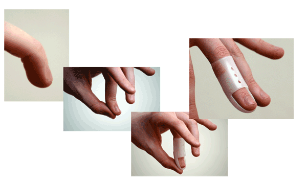 STAXX Pale Skin Tone 12 Mallet Finger Splints