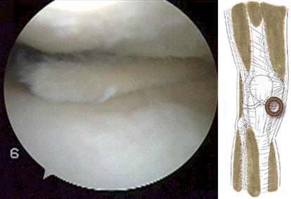 Meniscal Tear