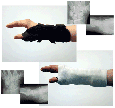 DonJoy® Comfortform™ Wrist with Abducted Thumb Splint