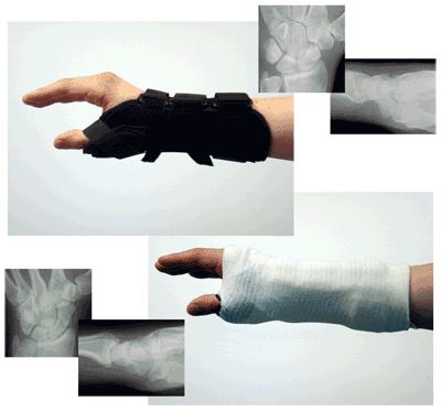 DonJoy Comfortform Wrist with Abducted Thumb Splint