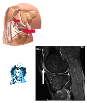 Hoffa's Posterior Fat Pad Syndrome