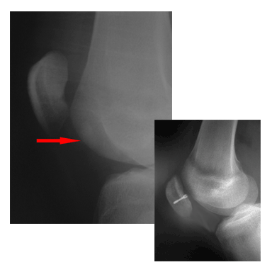 Acute Patella Dislocation