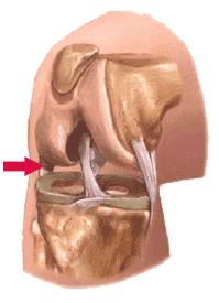 Lateral Collateral Ligament Injury