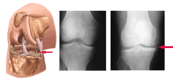 Knee Osteoarthritis