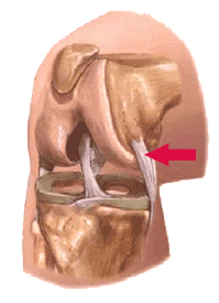 Medial Collateral Ligament Injury