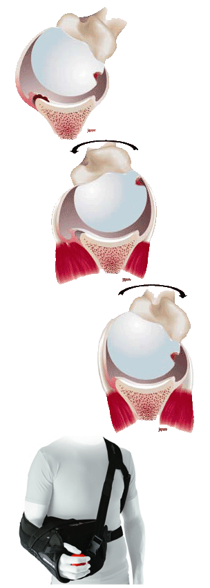 New DonJoy Ultrasling PRO Shoulder Braces